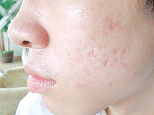 tiem-meso-tri-seo-ro-bi-quyet-lay-lai-lan-da-min-mang-2093-1 Nguyên nhân hình thành sẹo rỗ do mụn
