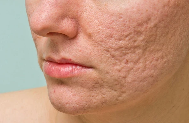 tiem-meso-tri-seo-ro-bi-quyet-lay-lai-lan-da-min-mang-2093 Sẹo rỗ là gì?